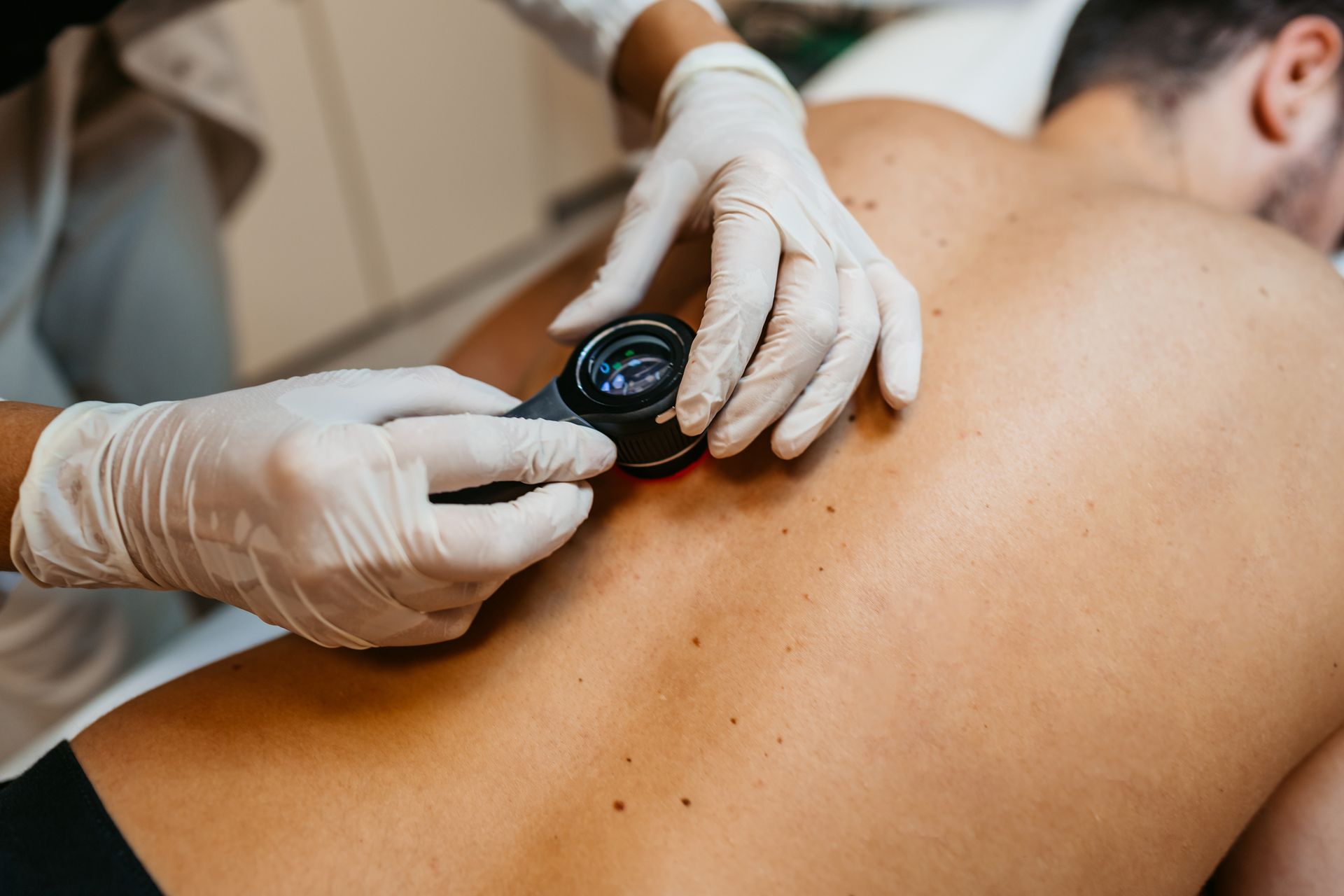Videodermatoscopia Digitale: Prevenzione Avanzata del Melanoma