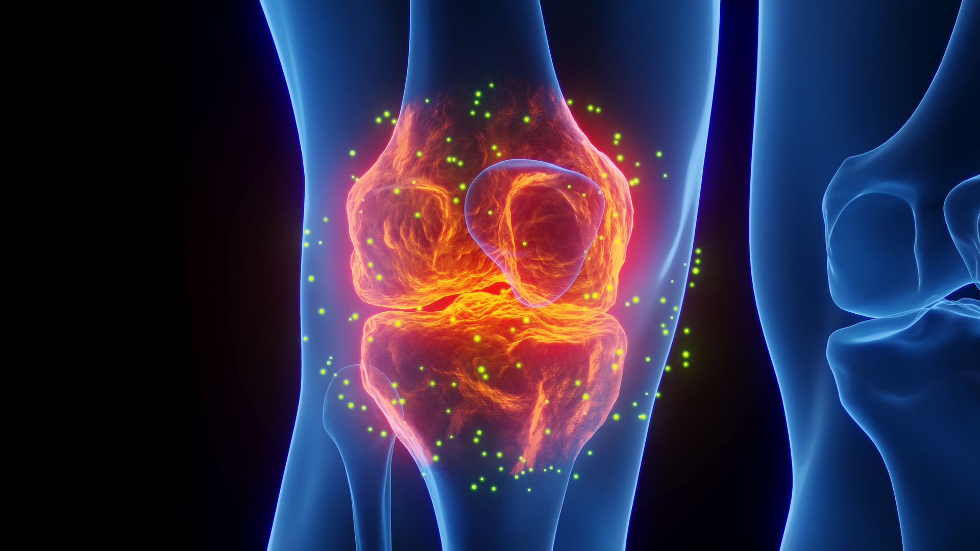 Diagnosi e Cura di Artrosi, Lesioni Meniscali, Legamentose e Tendinopatie